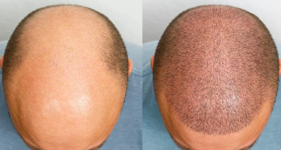 تركيا: الوجهة الأولى لزراعة الشعر بامتياز